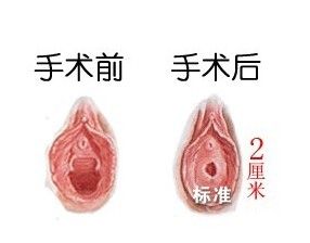 女性健康新选择，探索微创小手术的奥秘