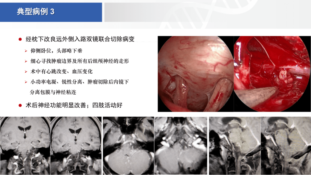 开颅手术后营养品的选择与恢复加速策略