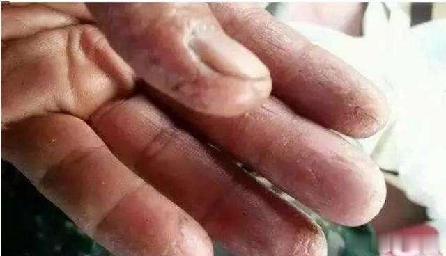 药物治疗，治疗失眠症的常用药物解析