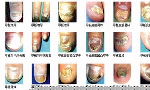灰指甲治疗新突破，揭秘知乎上最受推崇的特效药