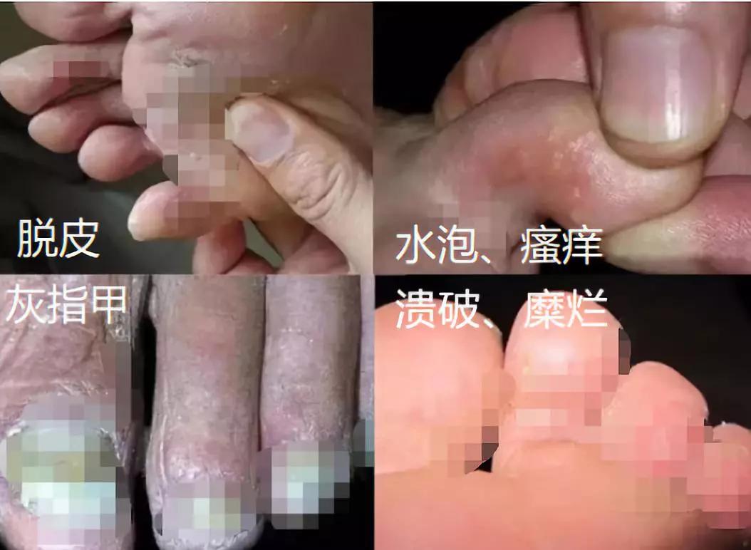灰指甲的克星，探索最有效的治疗特效药