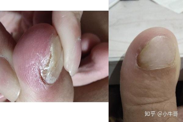 灰指甲的困扰与治疗，探寻最有效的特效药