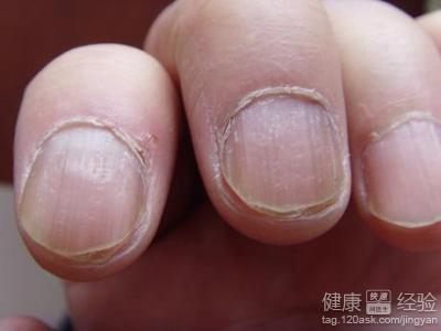 灰甲克星，探索治疗灰指甲的最佳药物方案