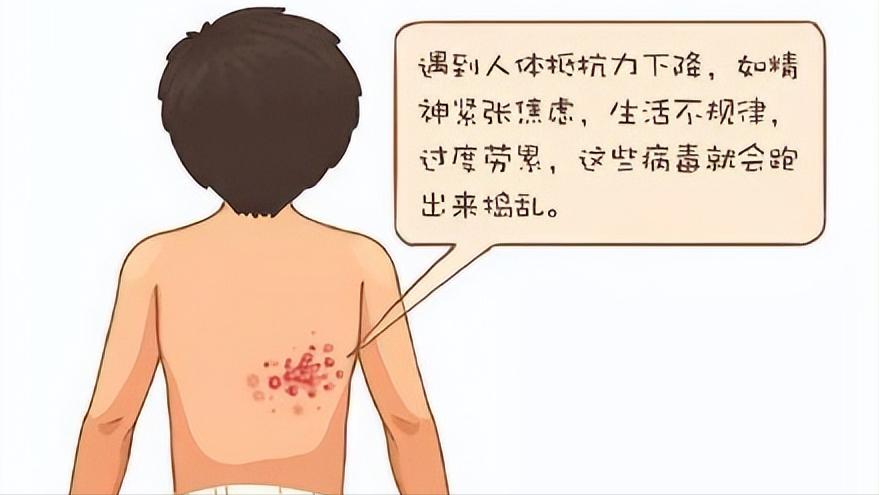 特效药治疗带状疱疹，科学探索与临床实践