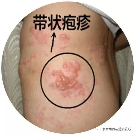 治疗带状性疱疹的抗病毒药物概览，选择与疗效解析