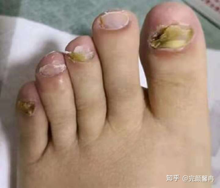 揭秘治疗灰指甲的秘密武器，最佳药膏大揭晓