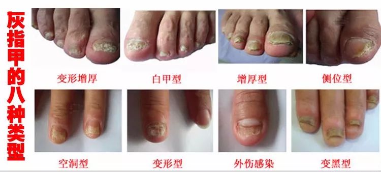 简单有效的灰指甲治疗法，家庭自疗指南