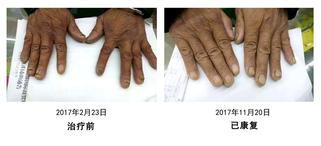 灰指甲的困扰与治疗，抗真菌药的角色
