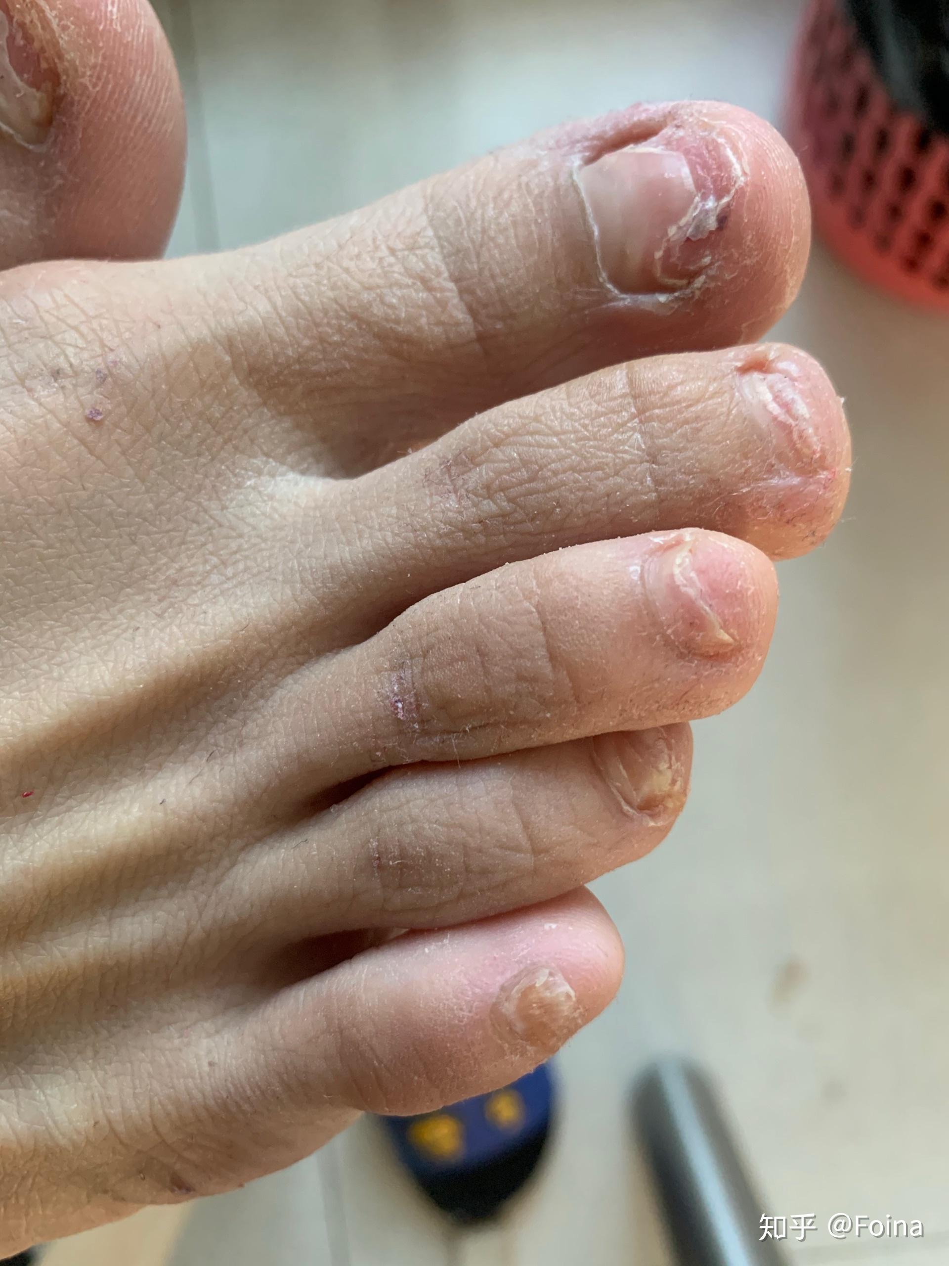 盐酸特比萘芬片，灰指甲治疗的优选良药