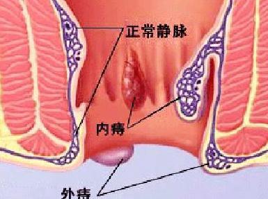 快速治疗痔疮，药物选择与效果评估