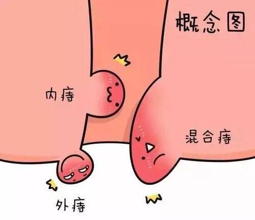 高效治疗内痔疮，探索最佳药物选择与策略