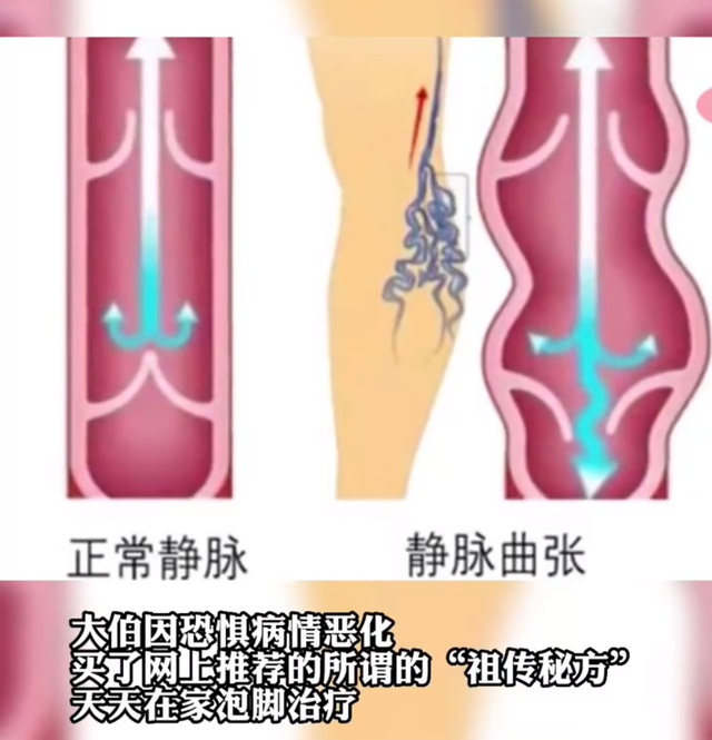 腿静脉曲张的全面解析与最佳治疗策略