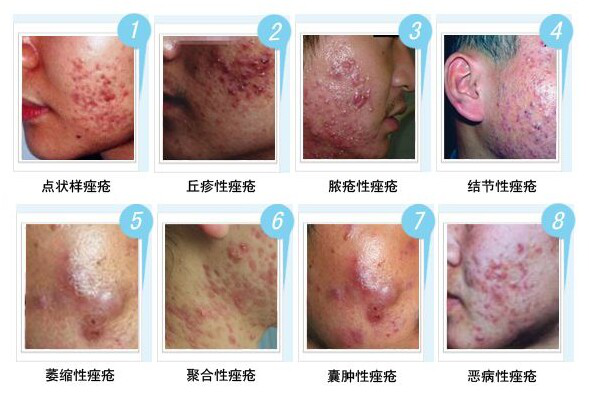 青春痘的全面解析与最佳治疗策略