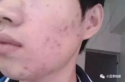 青春痘的全面解决方案，男孩的战斗指南