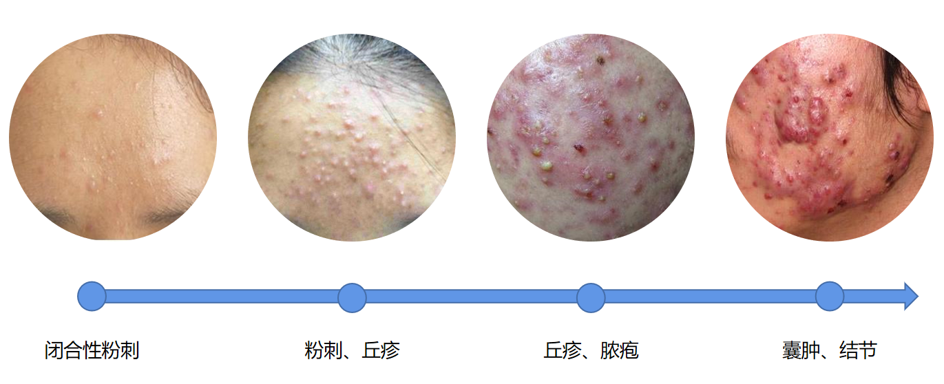 青春痘的烦恼与特效药治疗新篇章