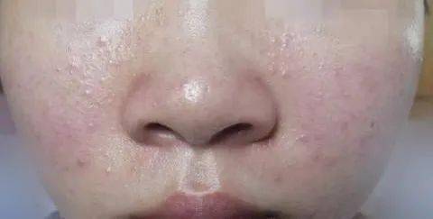 青春痘的烦恼与治疗良策，科学方法与日常护理并重