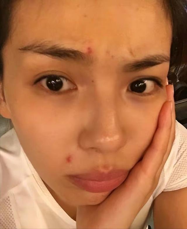 解锁肌肤秘密，揭秘治疗青春痘最有效的药膏