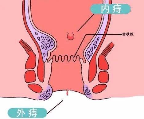 偏方治疗痔疮肉球的探索与解析