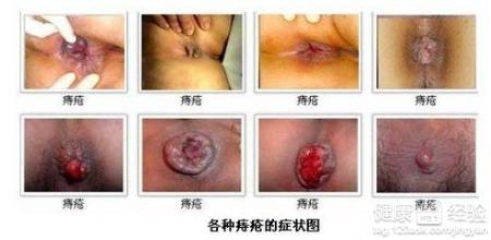 土偏方揭秘，地龙治疗痔疮的神奇疗效