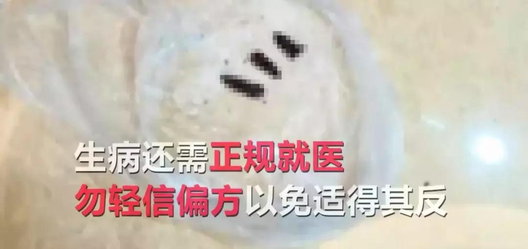 探索治疗萎缩性胃炎的天然小偏方，科学与传统的智慧融合