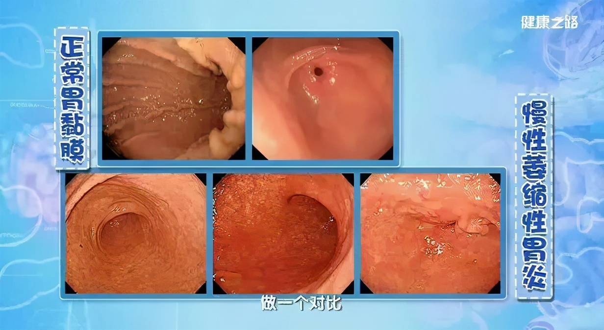 慢性萎缩性胃炎的中医治疗，十大中成药的全面解析