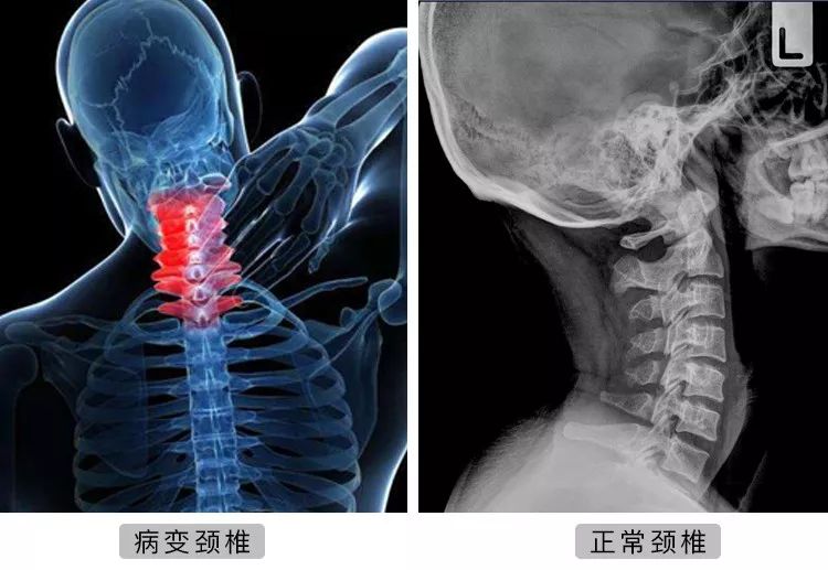 颈椎病的最佳5步操疗法，重获颈部健康的自然之选