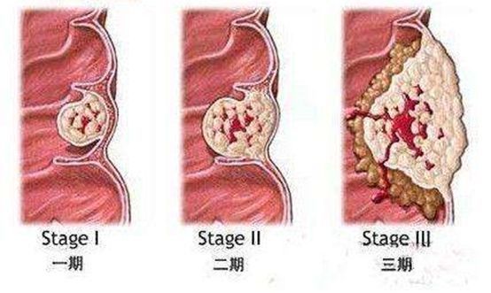 探索中医治疗痔疮的多元方法