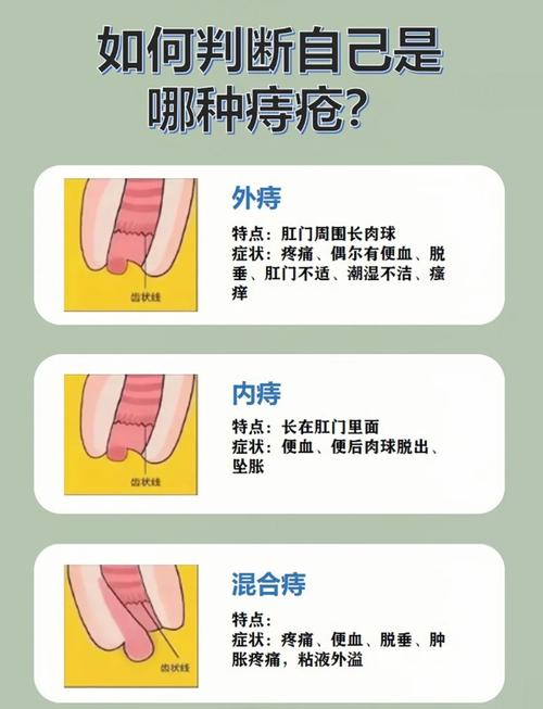 痔疮治疗最佳方法探析