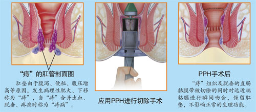 痔疮治疗新视角，内痔外露的全面解析与最佳治疗方案