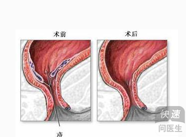 缓解痔疮困扰，有痔疮的人的多种治疗方法