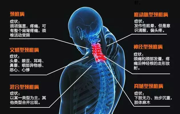 颈椎问题的全面解析与最佳治疗策略