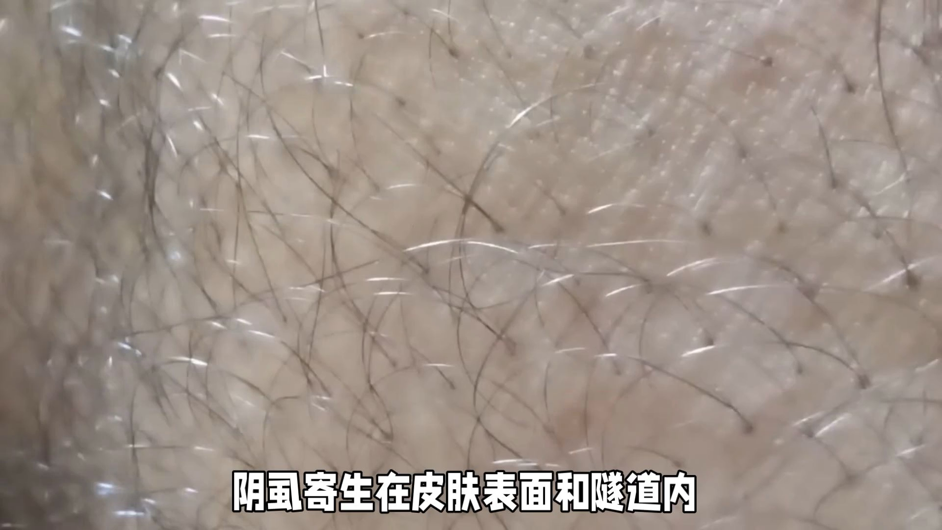 快速有效治疗女性阴虱的全面指南