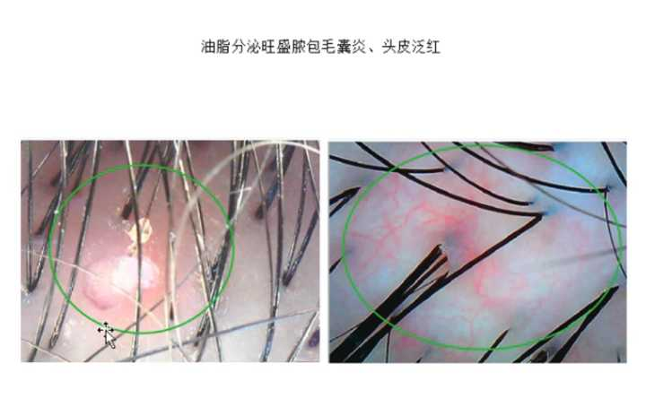 快速解决阴虱困扰，最有效的治疗视频指南