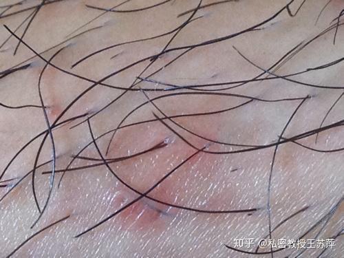 怎么治疗阴虱病最有效，全面指南与科学方法