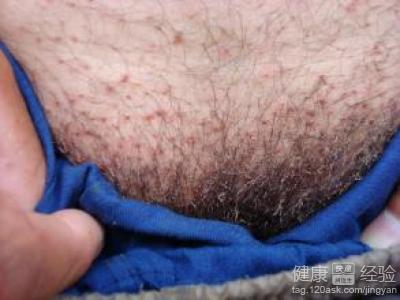 男性治疗阴虱的最佳药物选择