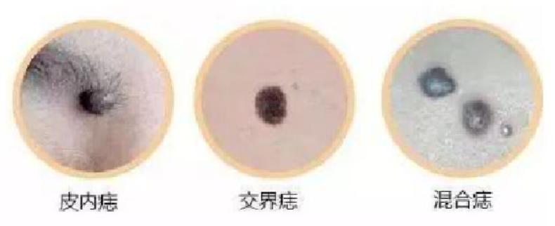 人民医院点痣价格解析，一颗痣的美丽投资