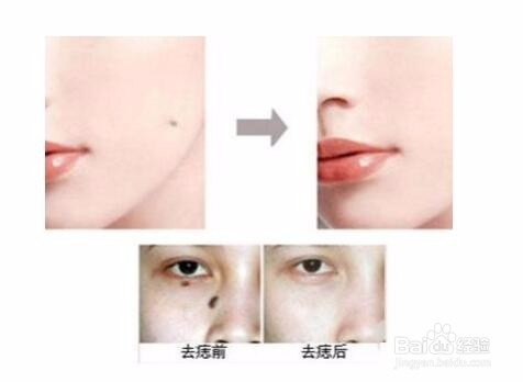 正规医院去痣价格全解析，一颗痣的美丽代价