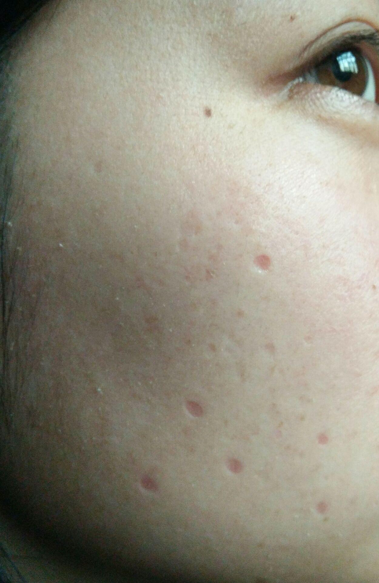 深圳点痣医院哪家强？专业指南助您找到最佳选择