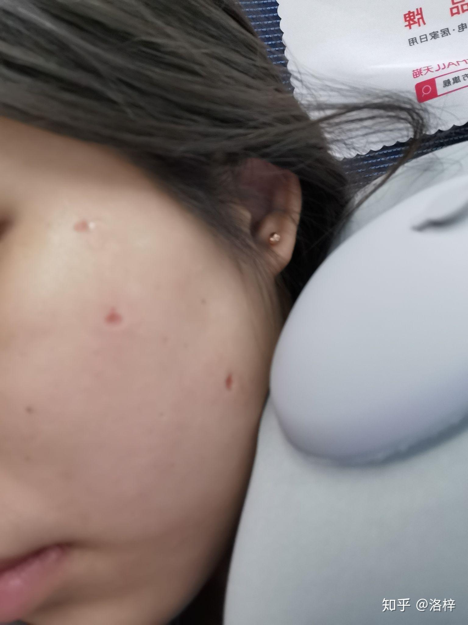 上海医院点痣价格，全面解析与选择指南