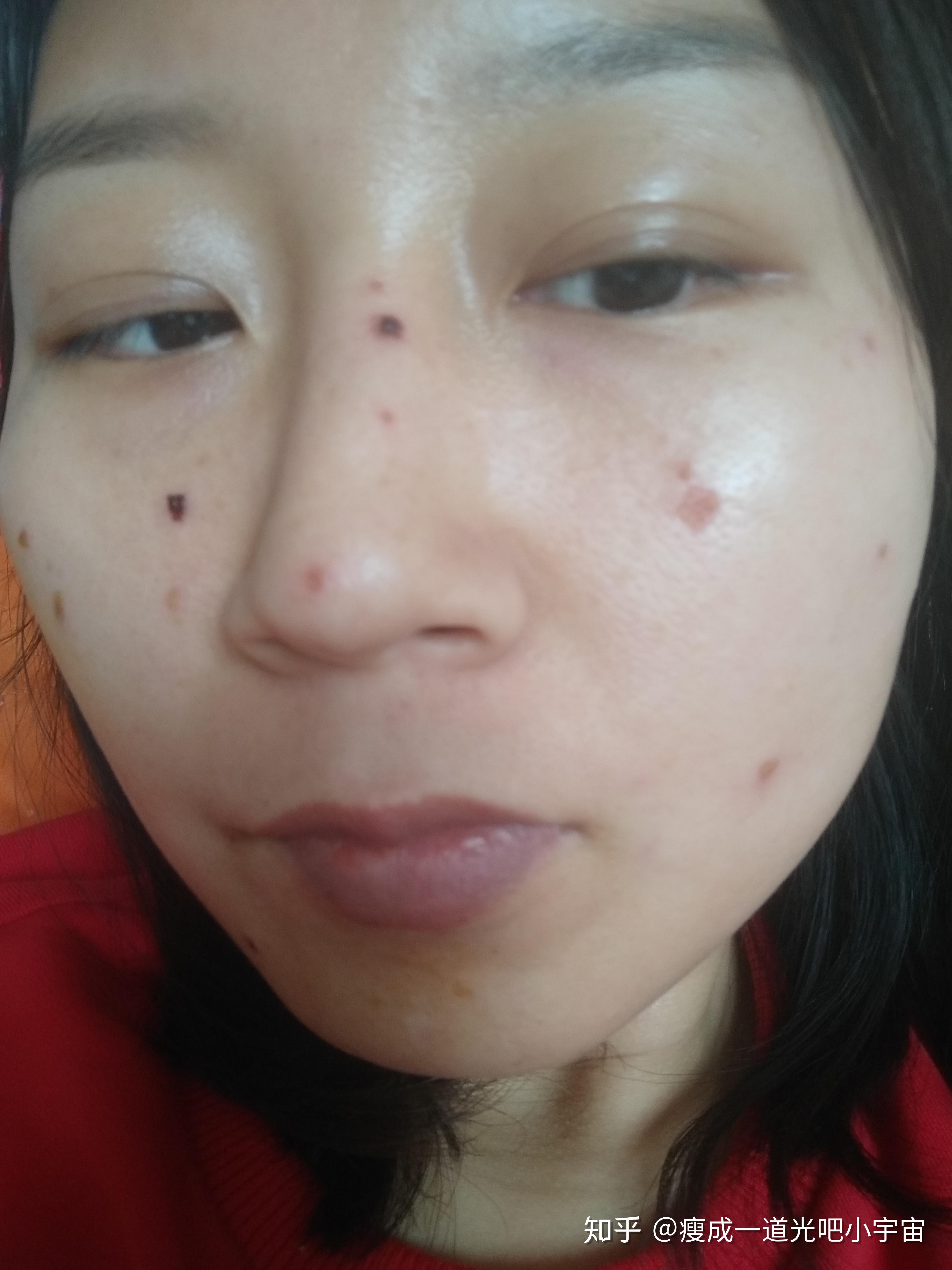 探秘上海医院激光点痣价格表，透明消费，美丽无负担