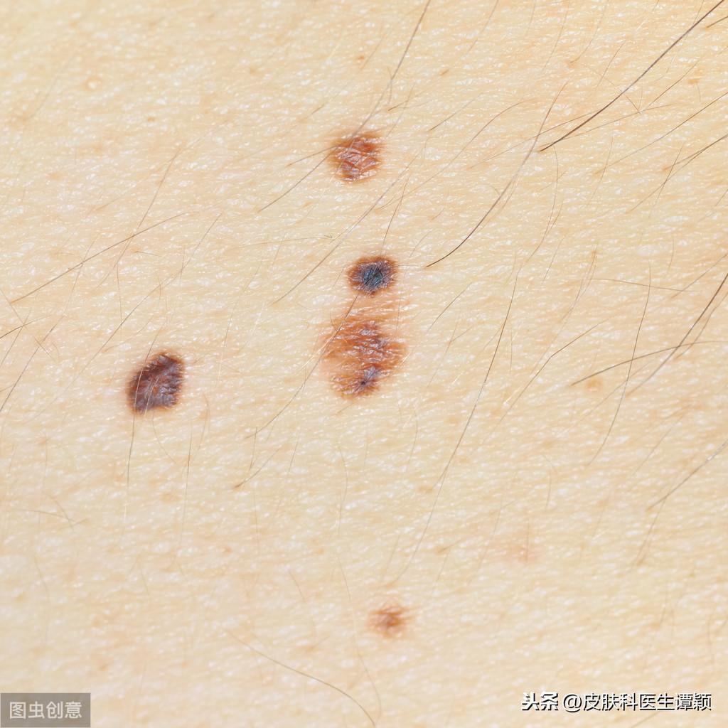 医院点痣，大痣处理的费用与最佳选择