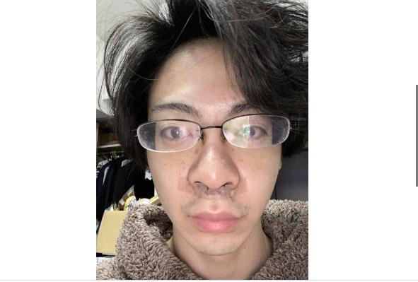 正规医院点一颗痣的合理费用与价值考量