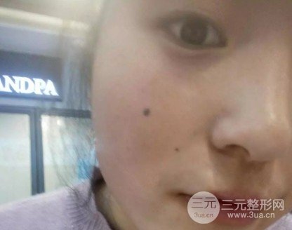 揭秘，去医院去痣的价格与价值——一颗痣的消失之旅