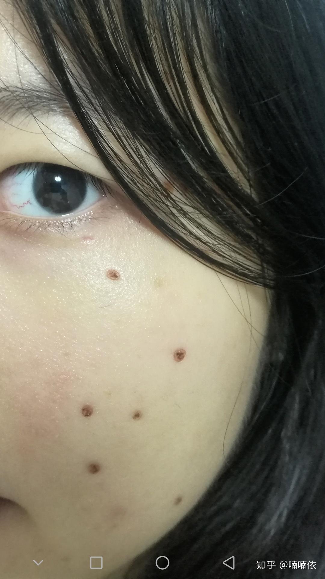 医院点痣，应该挂什么科？全面指南