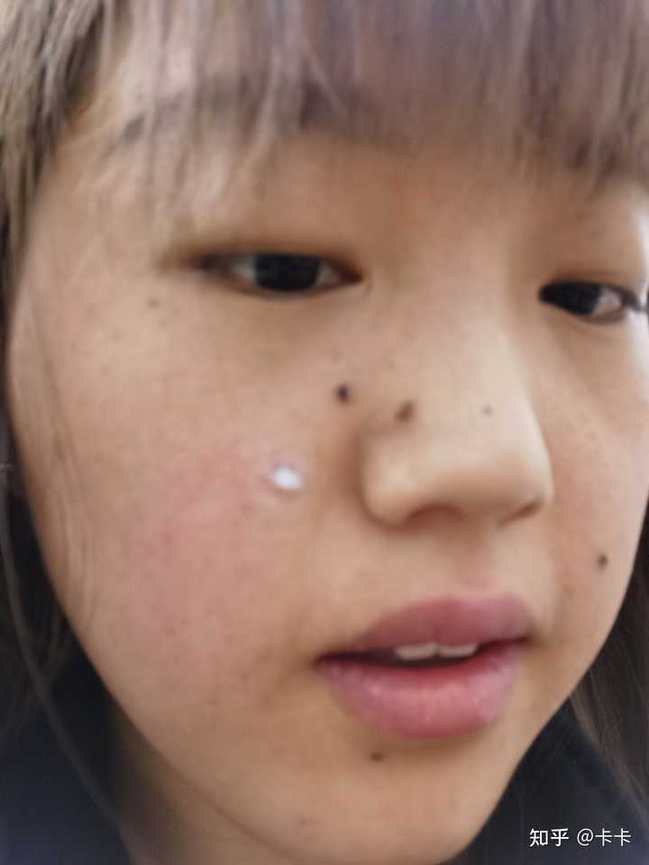 正规医院点痣价格全解析，安全与性价比的平衡点