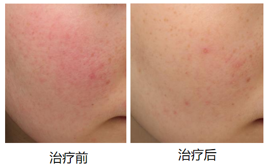 探寻北京点痦子专业医院，美丽之选，安心之托