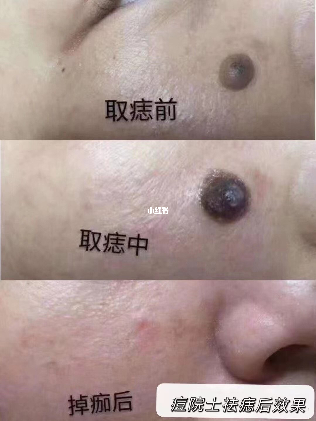 天津点痦子医院，专业服务，美丽新生的起点