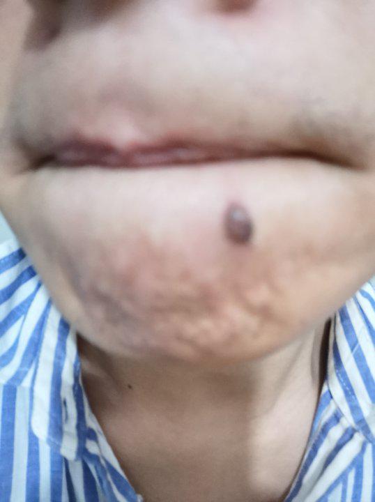 医院点痣，痦子去除的价码与考量