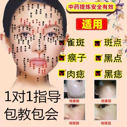 正规医院点痣价格，全面解析与注意事项