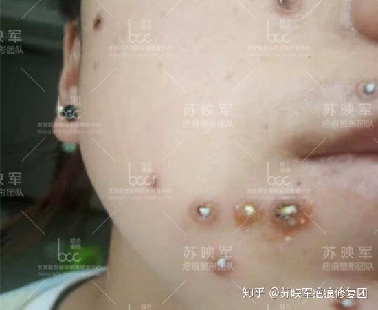点痣就医指南，选择正确的科室与注意事项